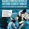 Illustrated Advanced Anterior Segment Surgery: A Step-by-Step Guide for Challenging Cases